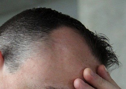 dealing with hair loss - riizehealth